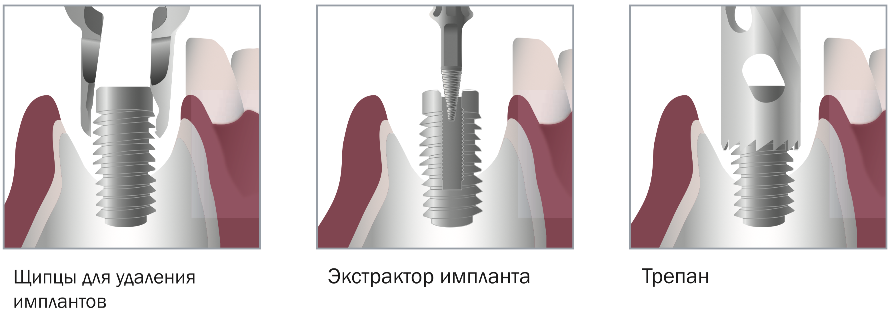 Техника применения Implant Remover Kit 