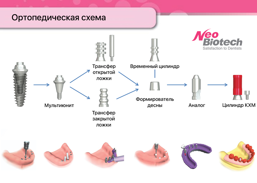 Трансферы имплантов