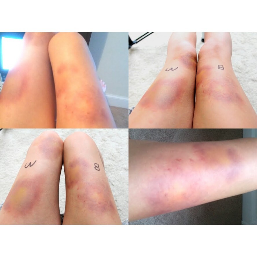 ProColoRing™ Bruise