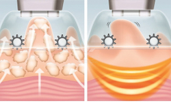 Антицелюлітний масажер Smoothee Cellulite Vacuum HoMedics