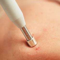 Насадка Серебряная стрела для аппарата Mesoform Pro версии Advance и Professional