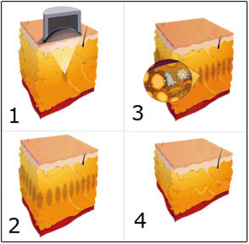 Косметологический аппарат LipoDerm