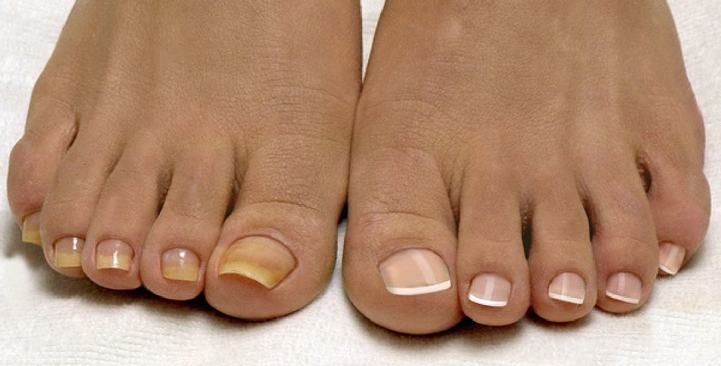 Почему ногти на руках желтые: причины, диагностика и лечение