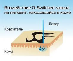 Неодимовий лазер для видалення татуювань mv4500