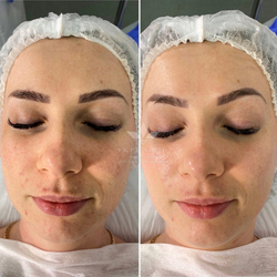 Тонізуючий лосьйон all-in-one для проблемної та жирної шкіри Acleon Seboderm Clarifying Toning Lotion