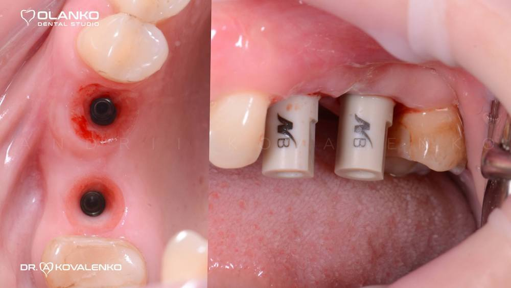 Скан-Абатмент NeoBiotech | Oral Scan Body