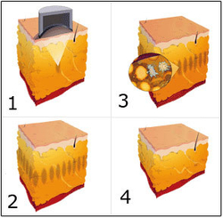 Косметологический аппарат LipoDerm