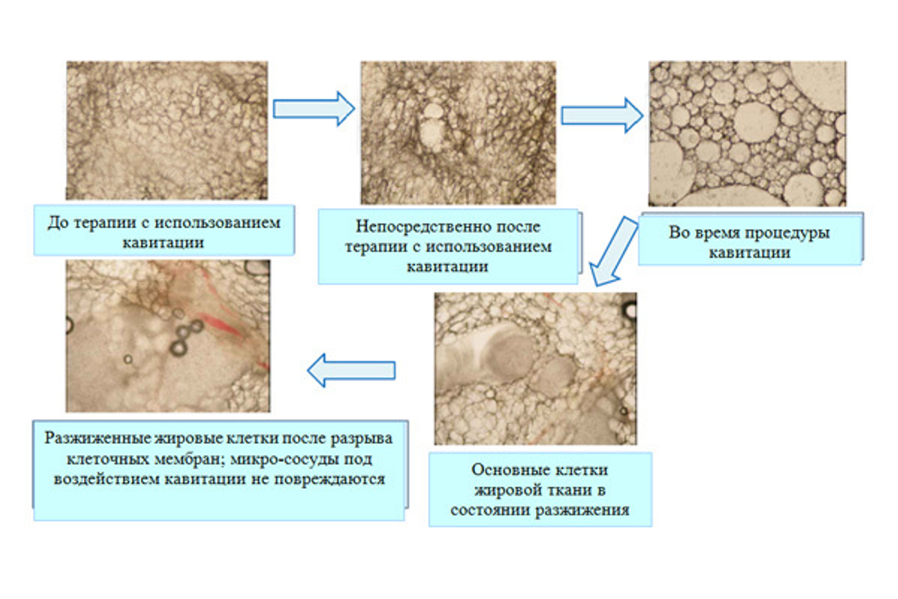 Косметологический аппарат LipoDerm