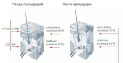 Косметологический аппарат MICRODERMABRASION DIAMOND SYSTEM