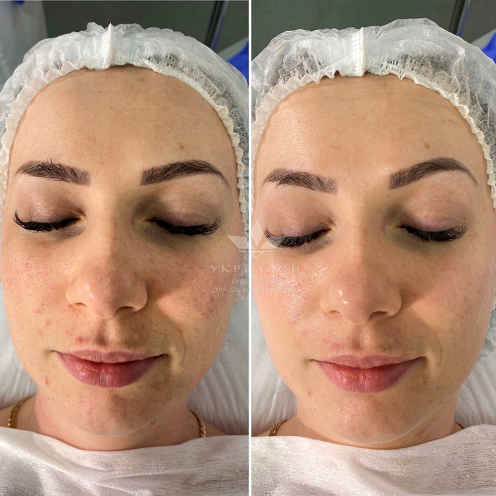 Тонізуючий лосьйон all-in-one для проблемної та жирної шкіри Acleon Seboderm Clarifying Toning Lotion