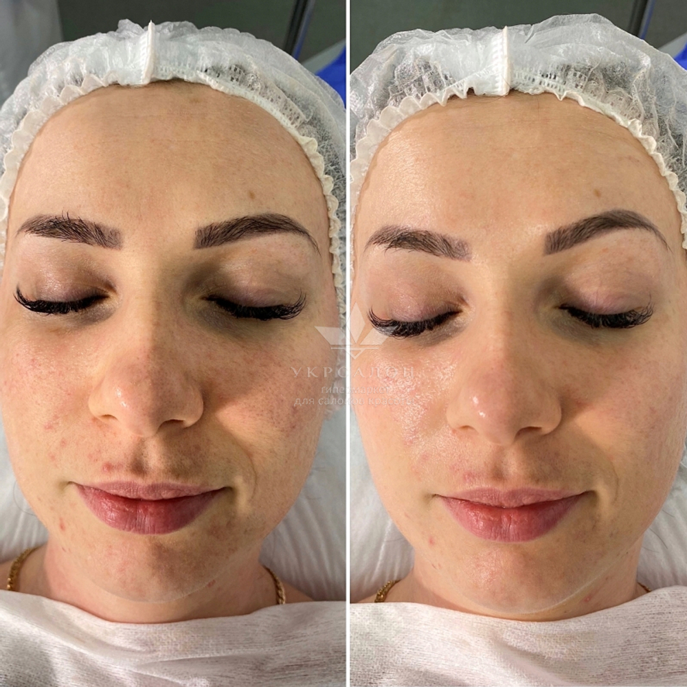 Висококонцентрована сироватка з зволожуючим і зміцнюючим ефектом Acleon Seboderm Solution Serum