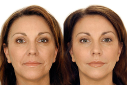 Косметологический аппарат LipoDerm