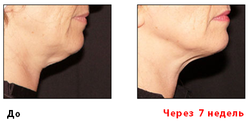 Аппарат для RF–лифтинга и электропорации «CareBuiw»