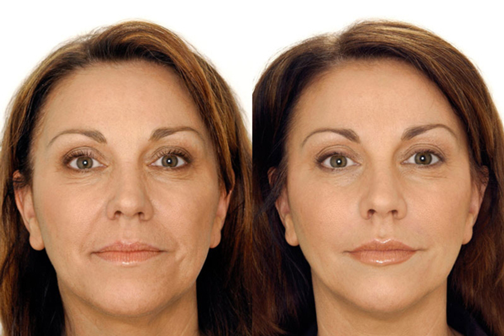 Косметологический аппарат LipoDerm