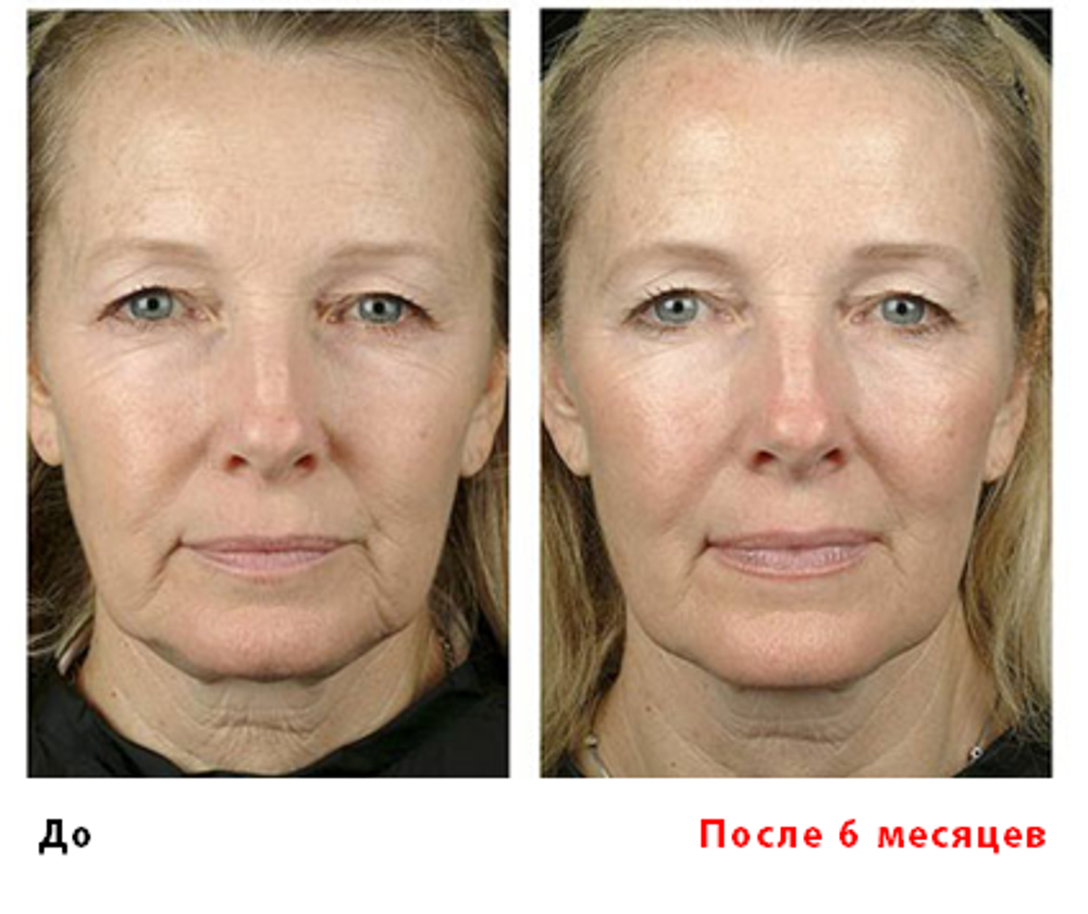 Аппарат для RF–лифтинга и электропорации «CareBuiw»