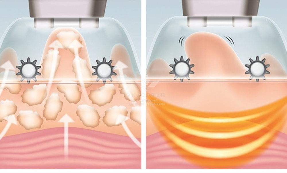Антицелюлітний масажер Smoothee Cellulite Vacuum HoMedics