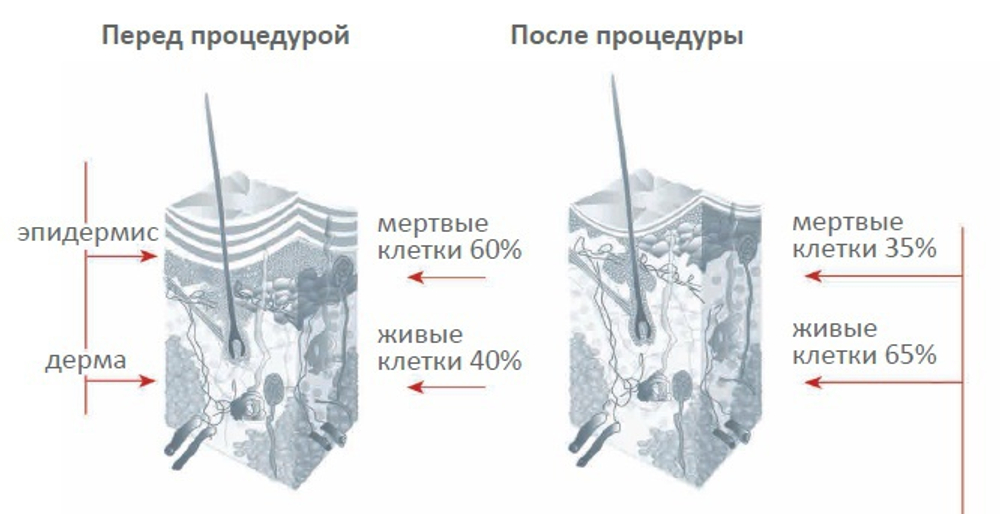 Косметологический аппарат MICRODERMABRASION DIAMOND SYSTEM