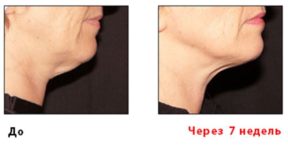 Аппарат для RF–лифтинга и электропорации «CareBuiw»