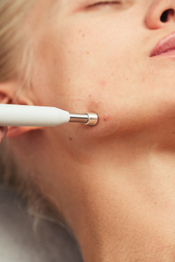 Насадка Серебряная стрела для аппарата Mesoform Pro версии Advance и Professional