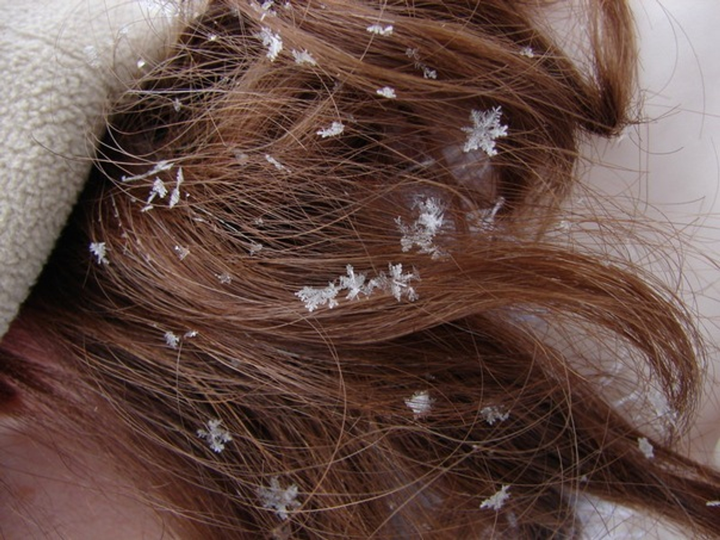 Снежинки на волосах.